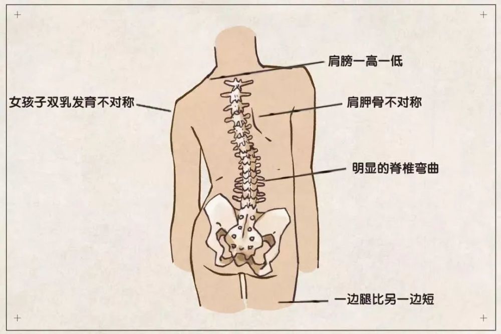 逆境中的希望，留守女孩脊柱侧弯的挑战与奋斗之路