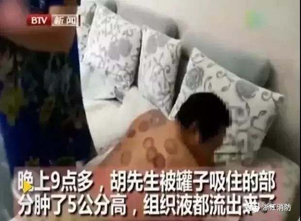 男子拔火罐遭遇大面积烧伤，传统疗法安全与风险需警惕