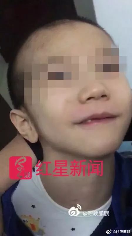 女童遭老师砸伤，母亲抗诉之路遇阻