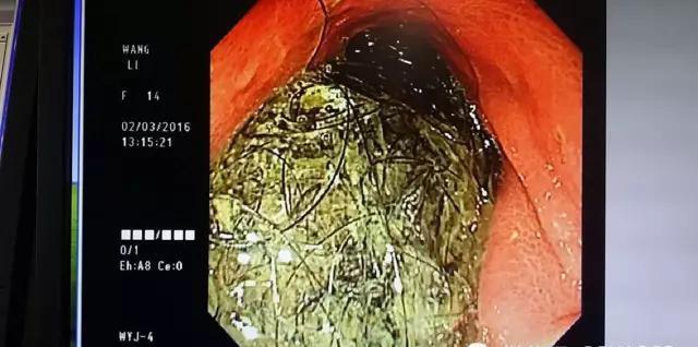 九岁女孩胃里惊现四厘米头发团，误食与医疗应对探究