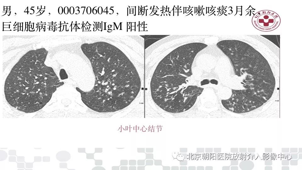 甲流后发烧引发病毒性肺炎，疾病演变与防治策略需警惕